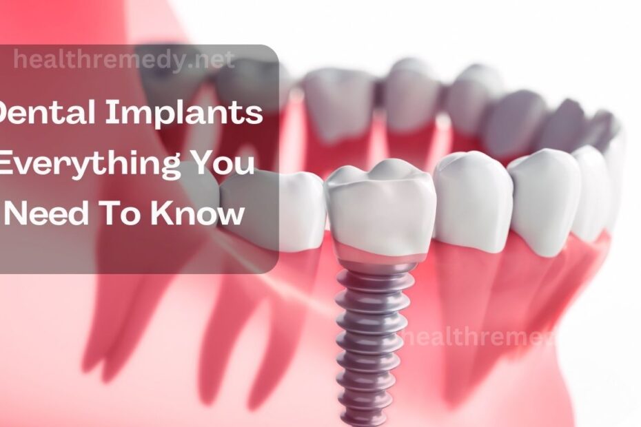 Dental Implants